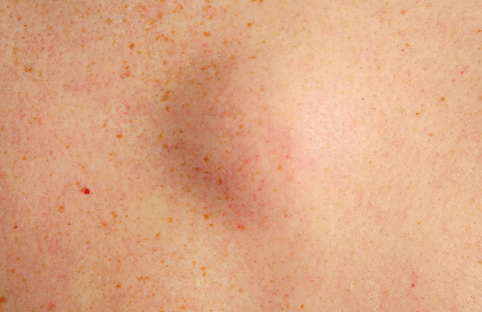 Lipome les solutions pour s’en débarrasser Dr Petit Paris