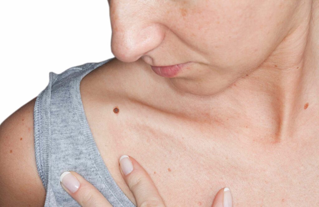 Peut-on retirer un grain de beauté ? | Dr Petit | Paris