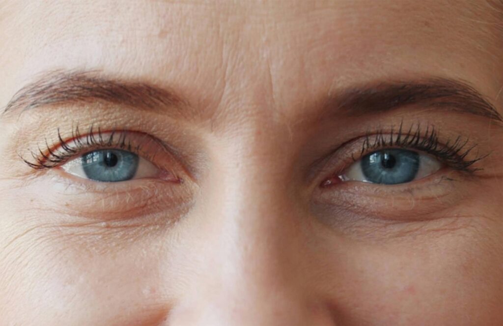 Je regrette ma blépharoplastie