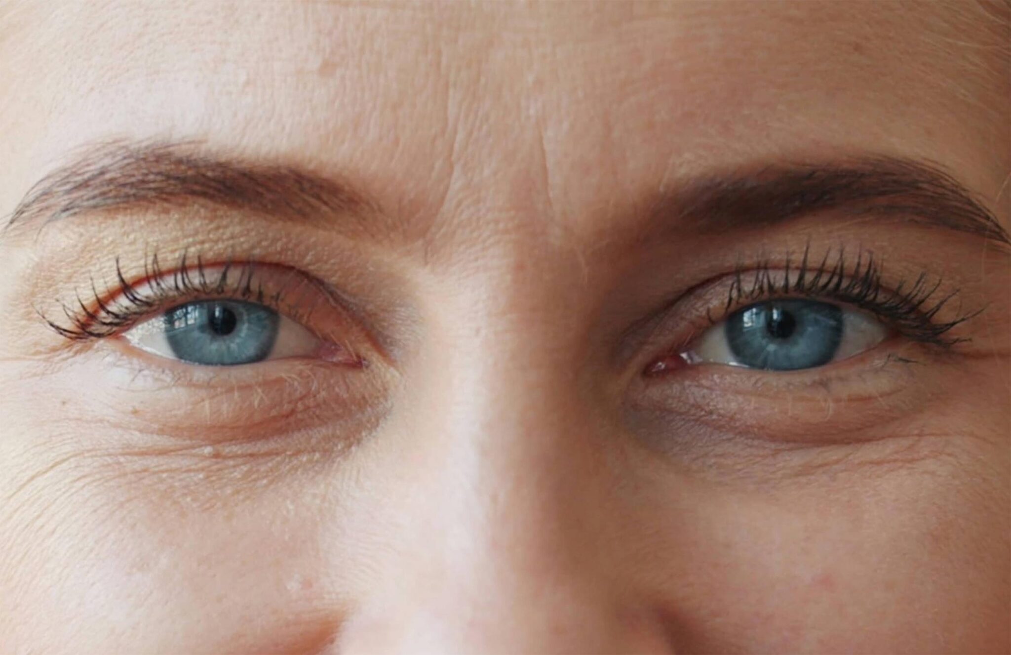 Je regrette ma blépharoplastie