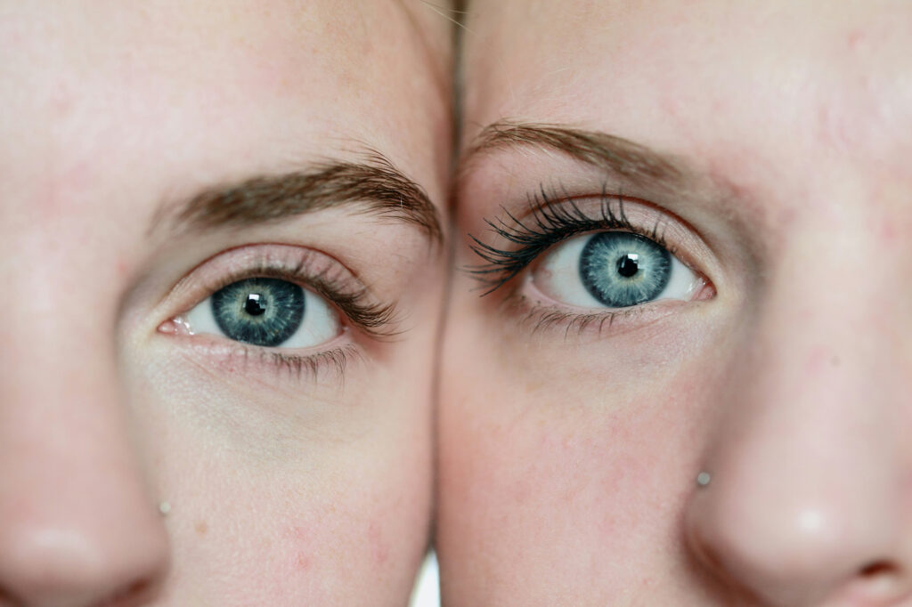 Blépharoplastie : combien de temps dure l'œdème ? | Dr Petit