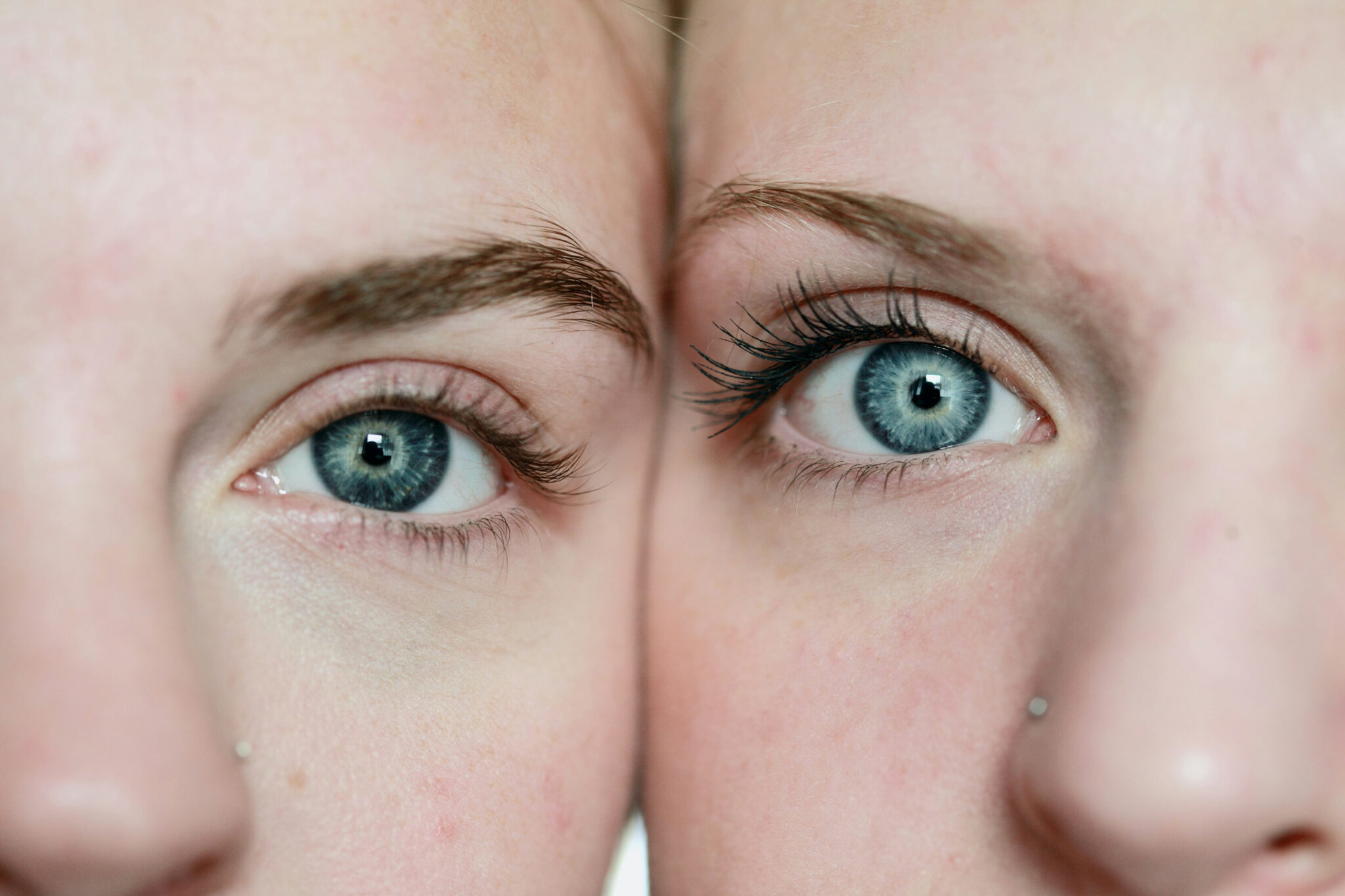 Blépharoplastie : combien de temps dure l'œdème ? | Dr Petit